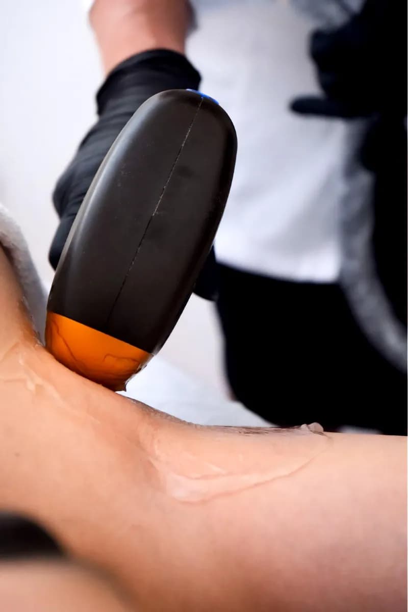 Laser Virilha Perianal em Coimbra — Alessandra Gomes Estética