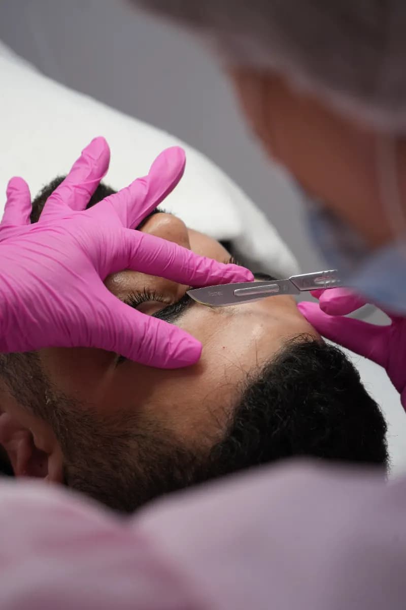Tratamento Rosacea